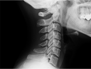 頚椎のレントゲン写真